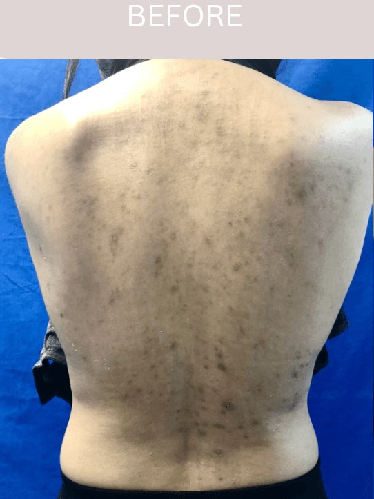 Laser Scar Treatment Before