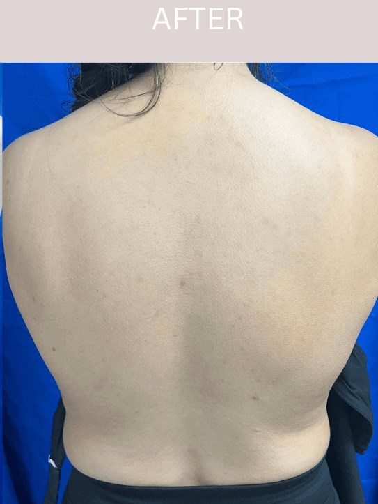Laser Scar Treatment After