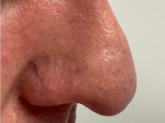 IPL photo facial Before