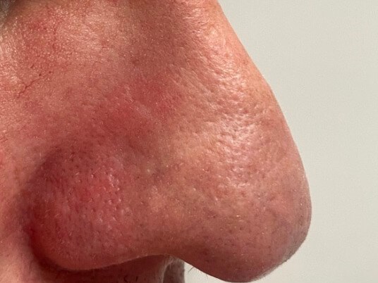 IPL photo facial After