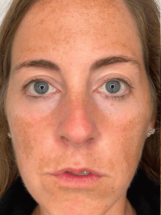 Clearlift for Melasma Before
