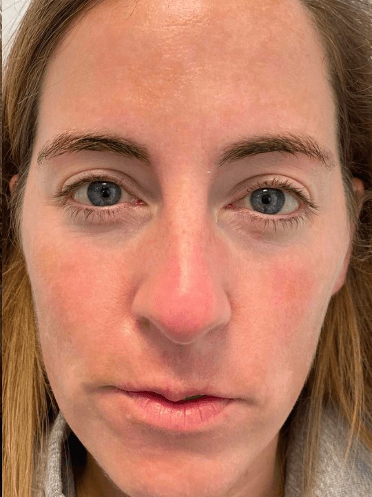 Clearlift for Melasma After