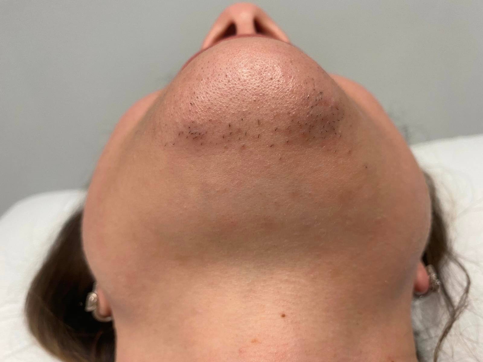 Laser hair removal before