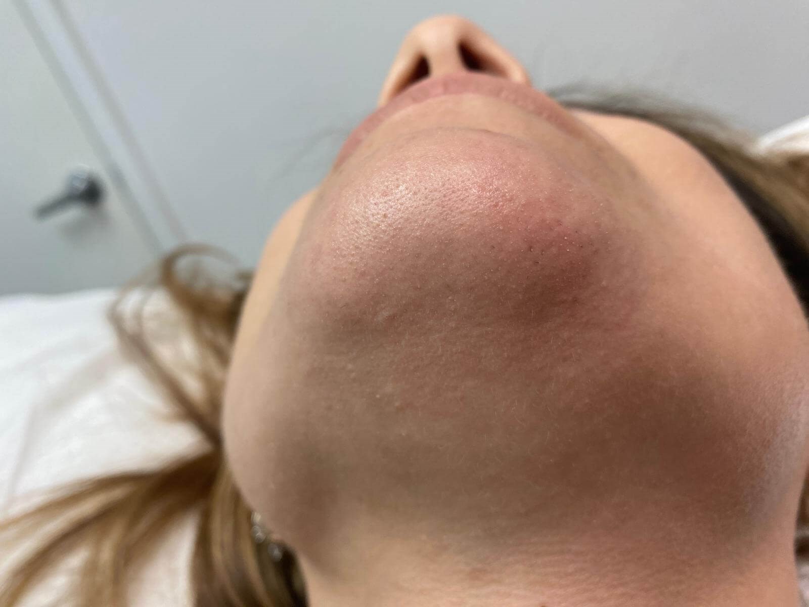 Laser hair removal after