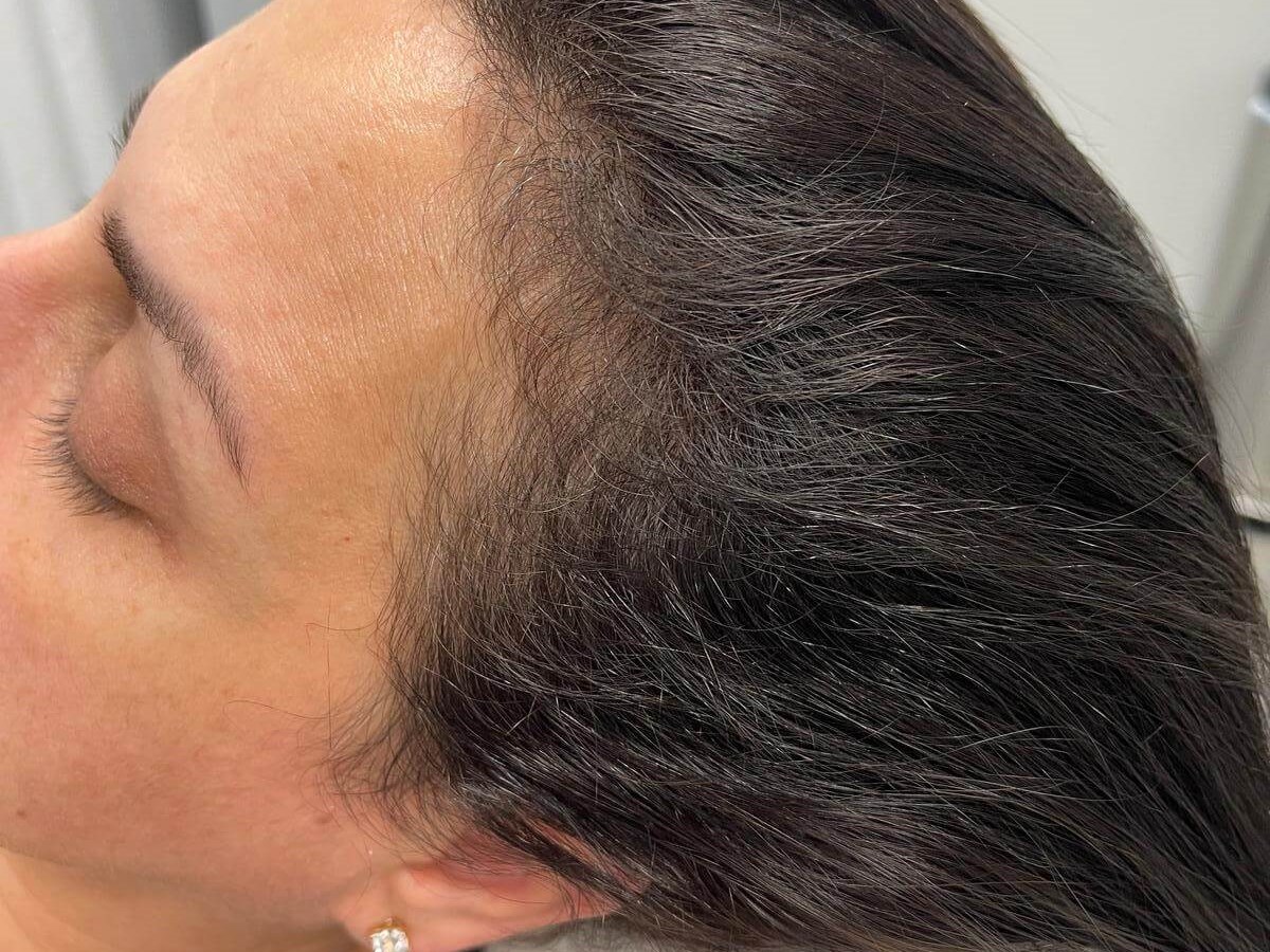 Alma TED hair restoration After