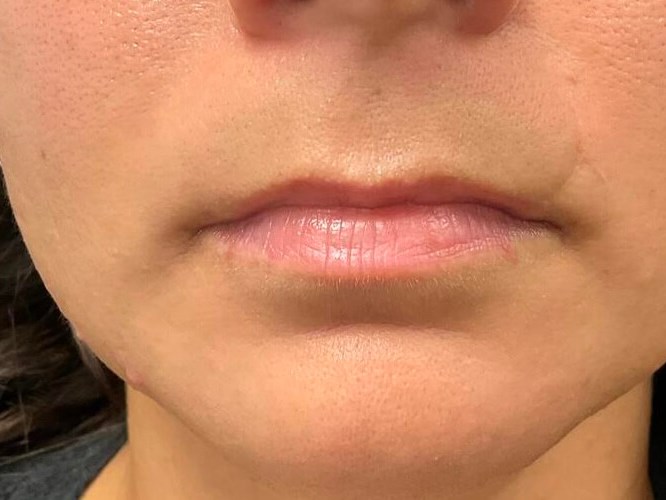 Lip filler Before