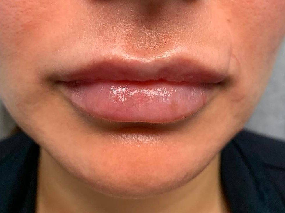 Lip filler After