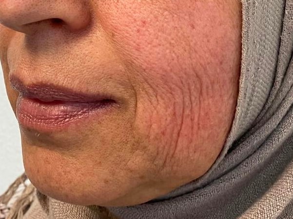 Clearlift skin tightening Before