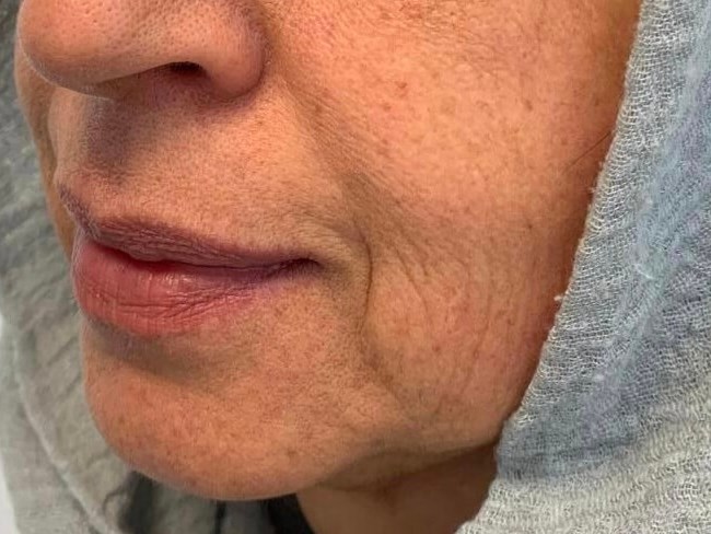 Clearlift skin tightening After