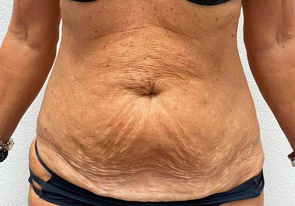 Erbium skin tightening Before