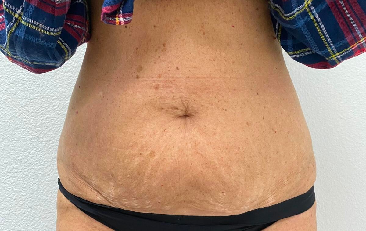 Erbium skin tightening After