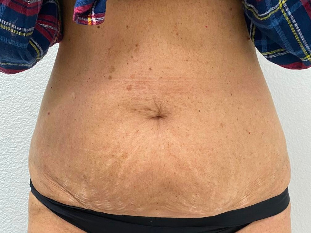 Erbium skin tightening After