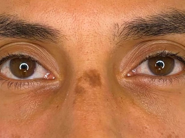 Laser scar reduction Before