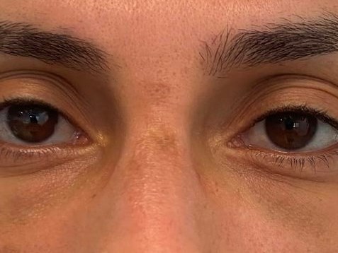 Laser scar reduction After