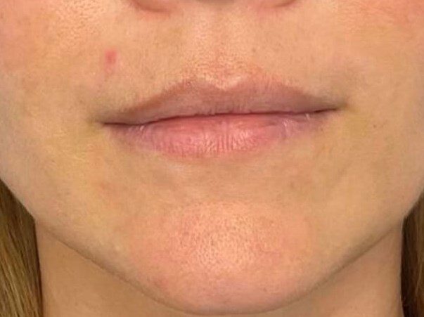 Lip Filler Before