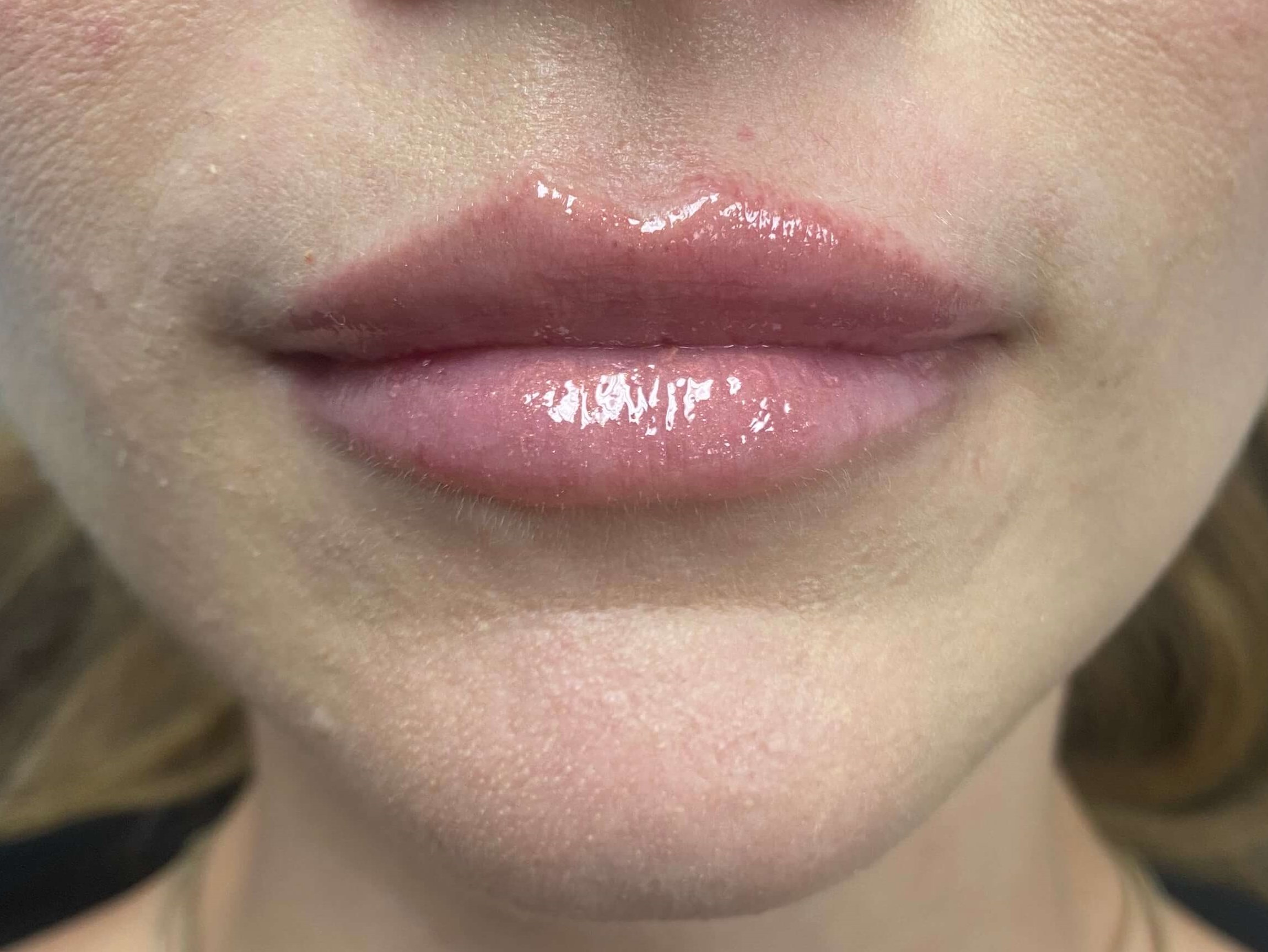 Lip Filler After