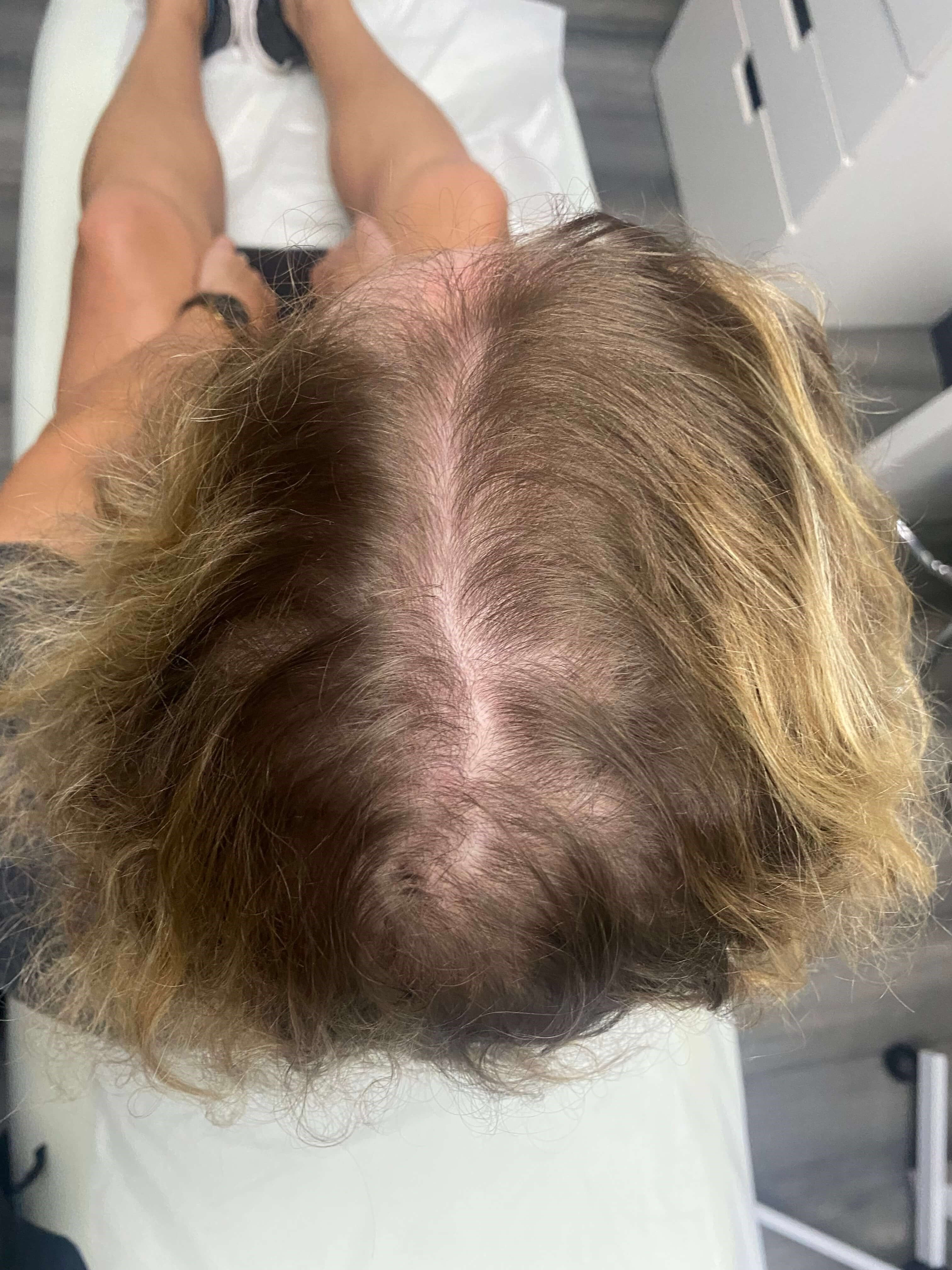 PRP Hair Restoration After