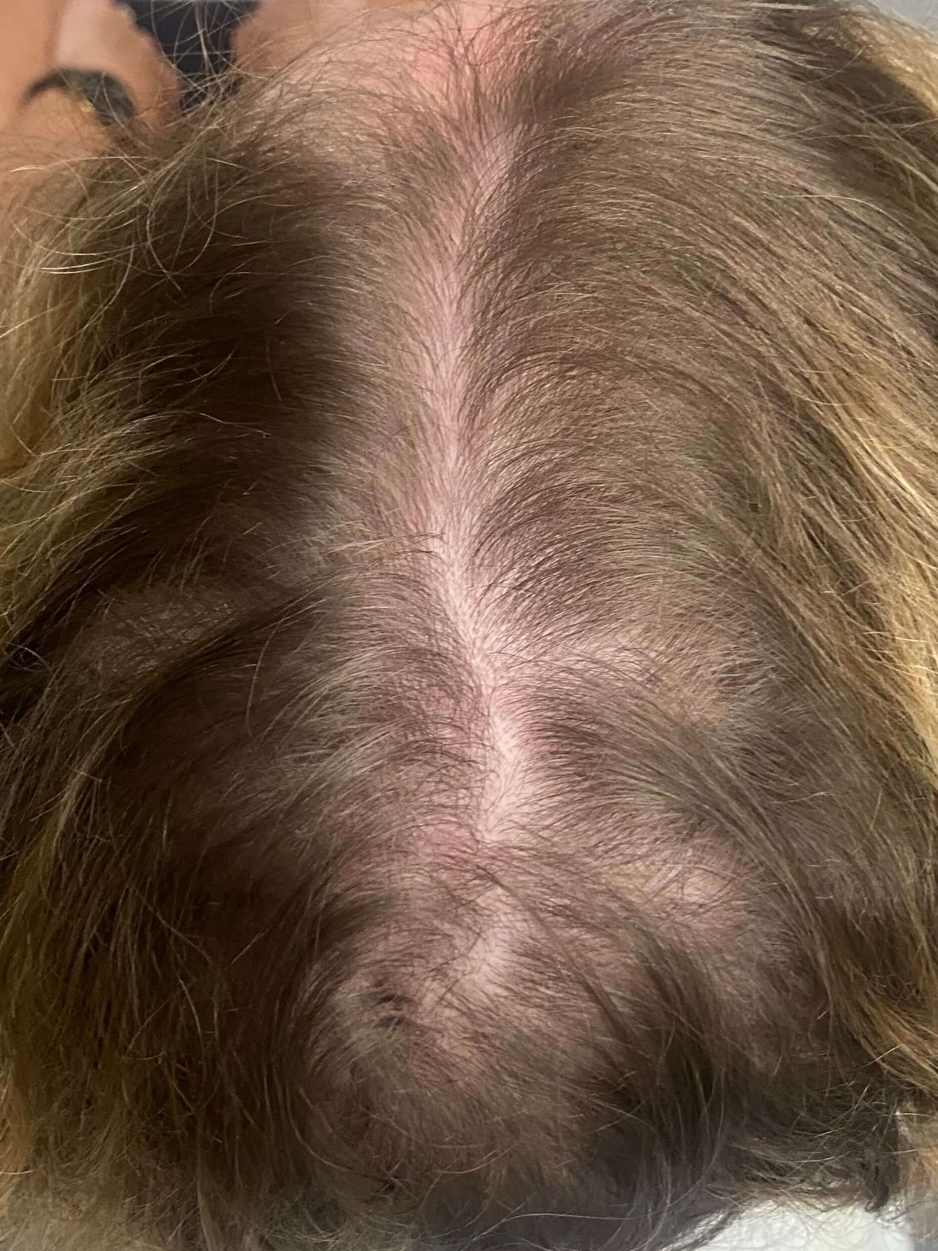 PRP Hair Restoration After