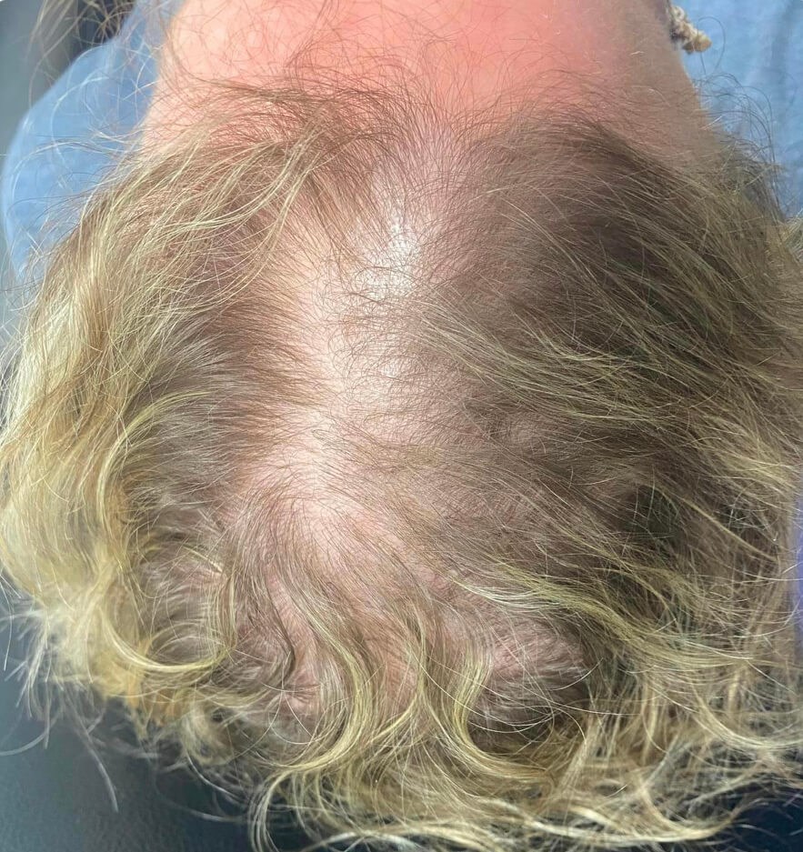 PRP Hair Restoration Before