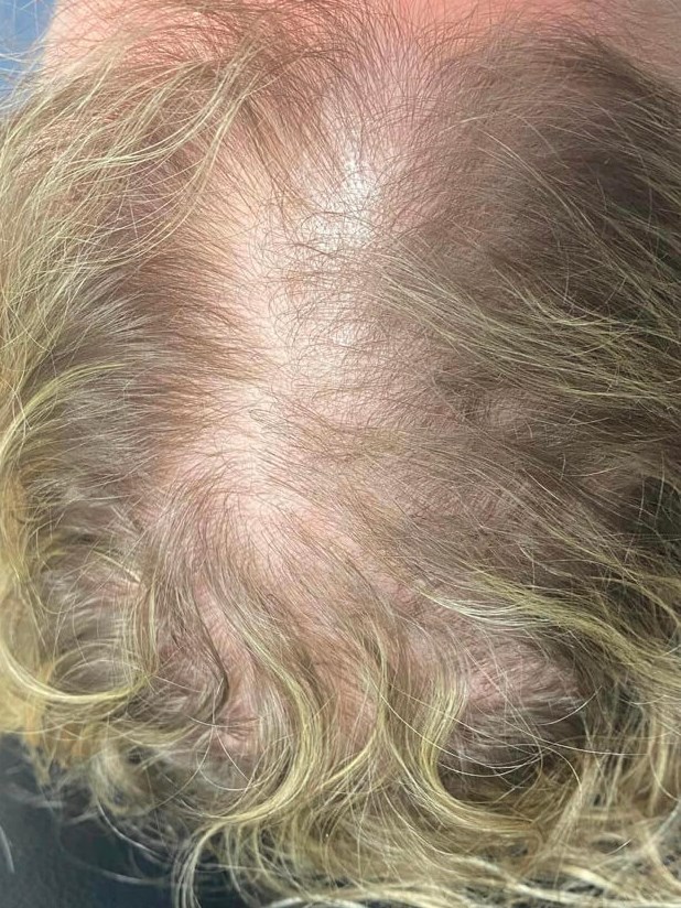 PRP Hair Restoration Before