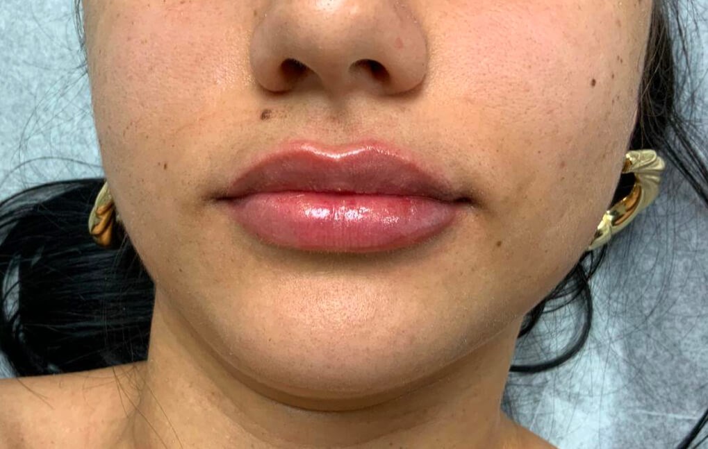Lip Filler After
