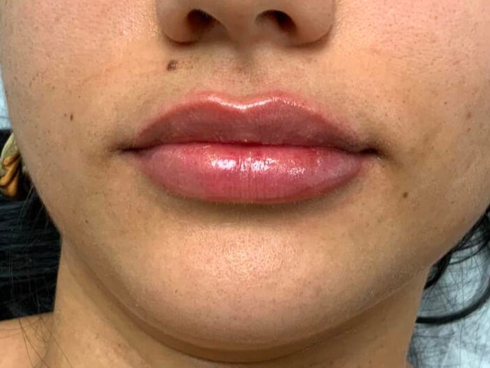 Lip Filler After