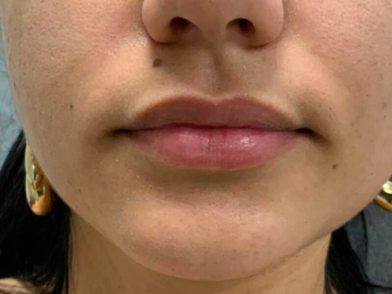 Lip Filler Before