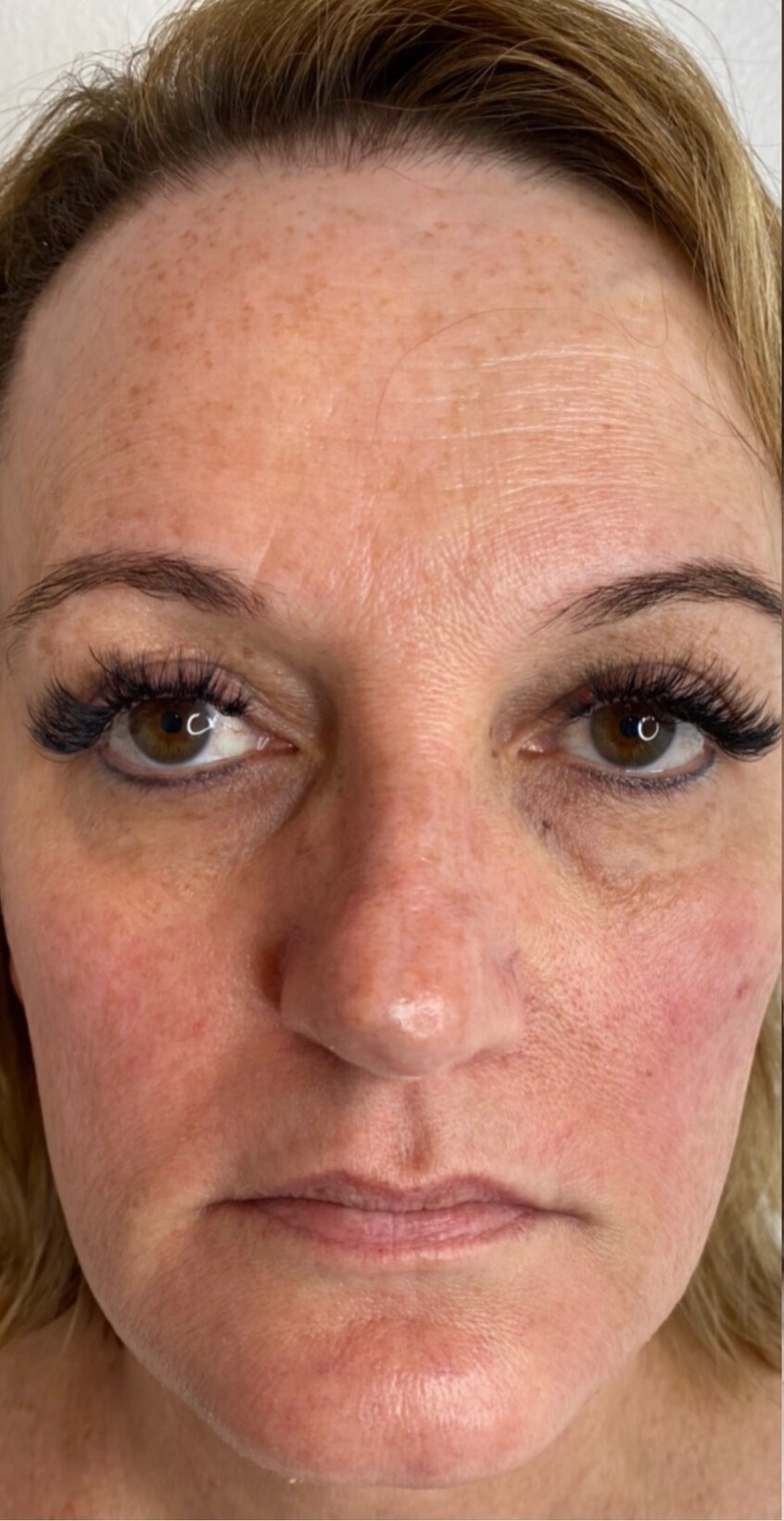 Combo Laser Treatment Before