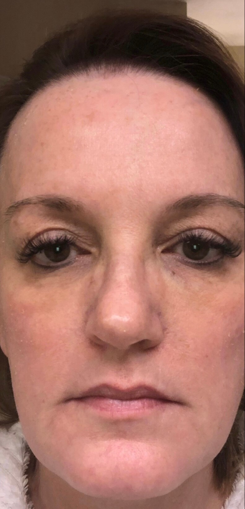 Combo Laser Treatment After