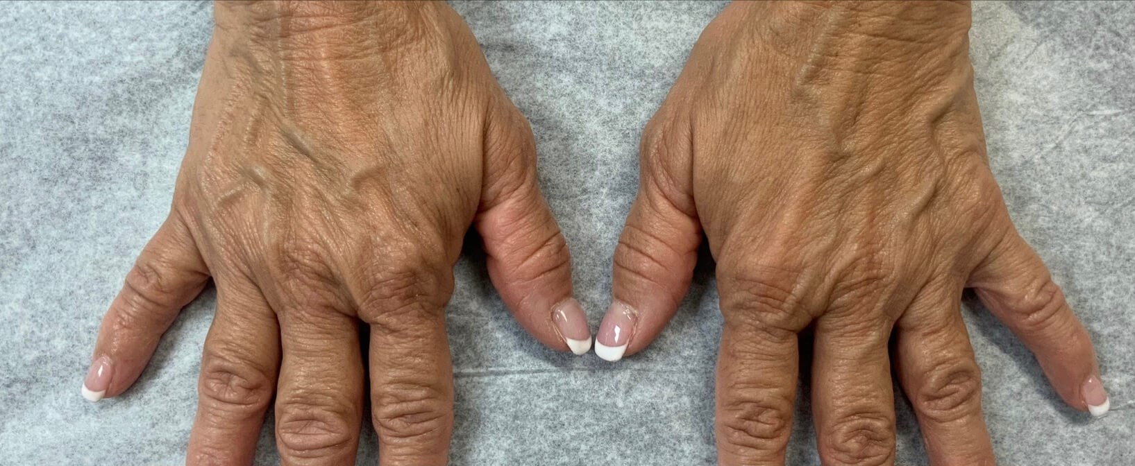 Radiesse Hand Treatment Before