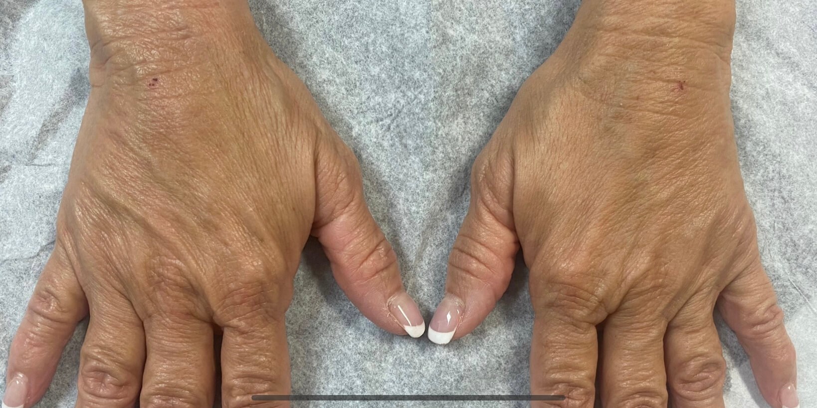 Radiesse Hand Treatment After
