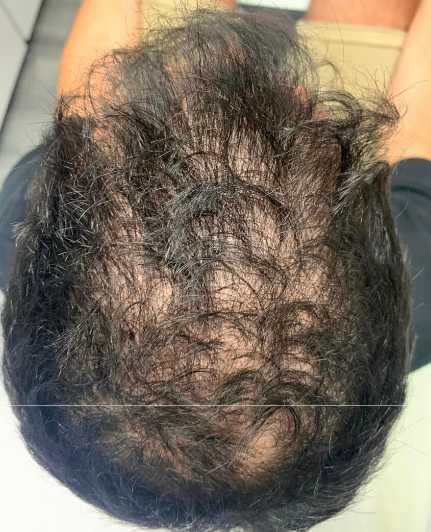 Keravive Scalp Treatment Before