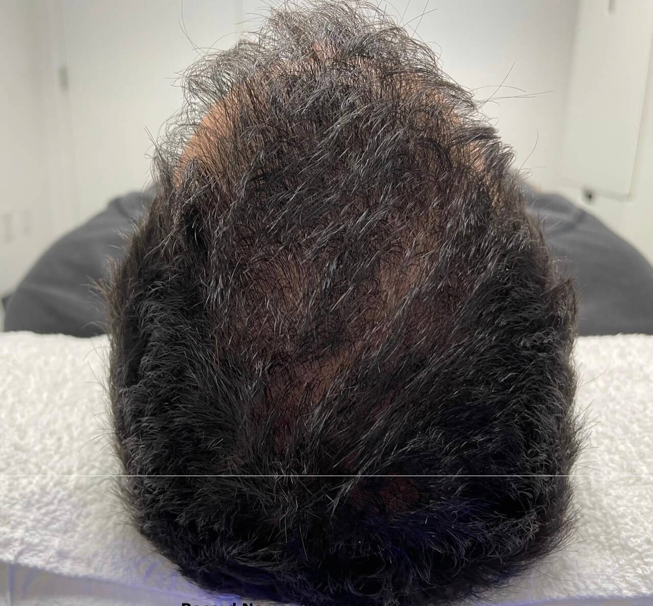 Keravive Scalp Treatment After