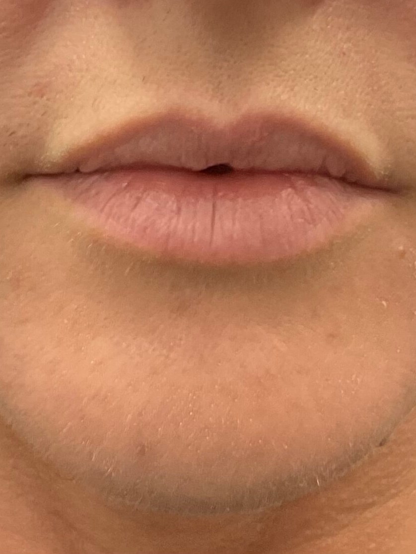 Lip Filler Before