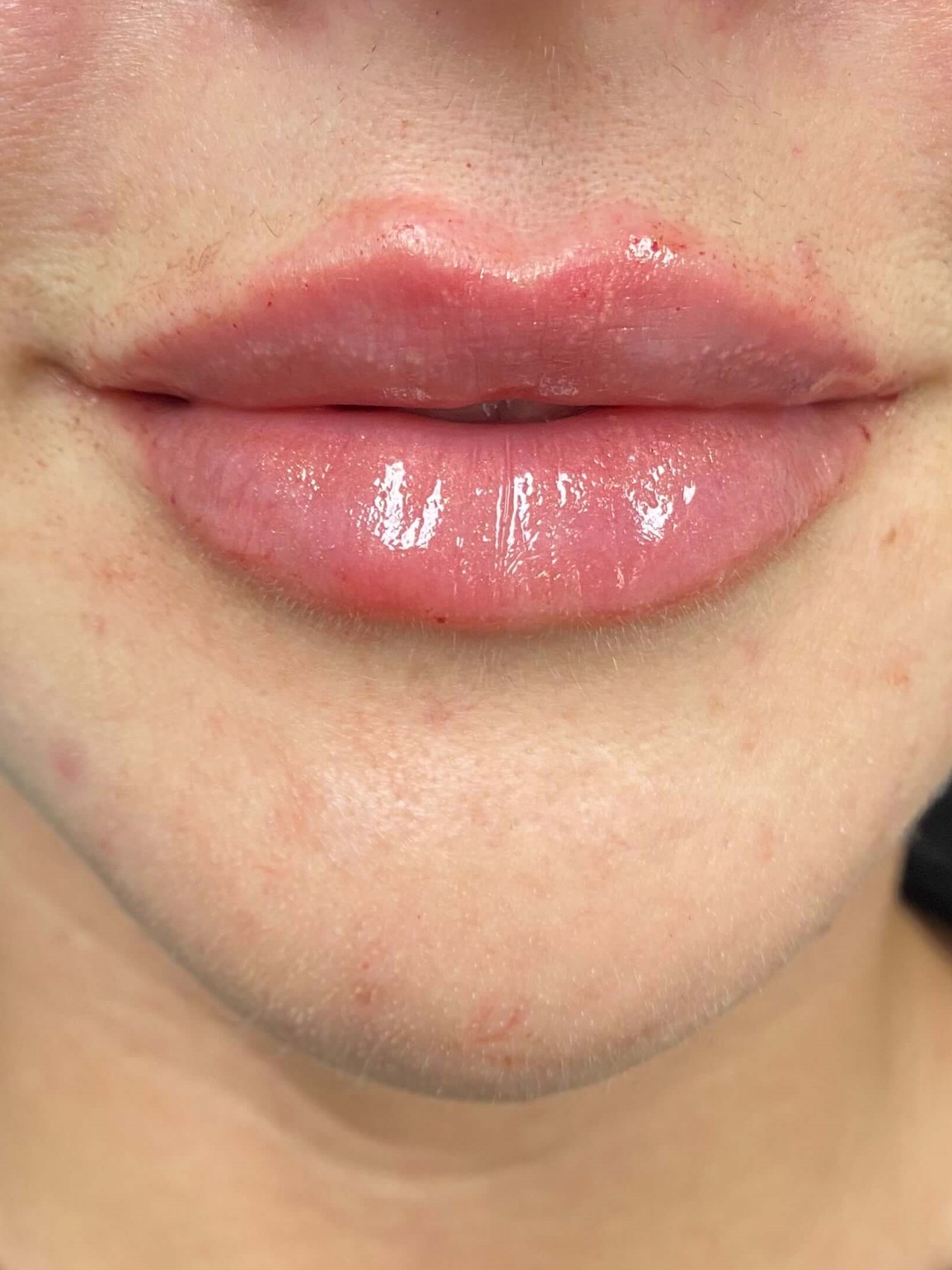 Lip Filler After