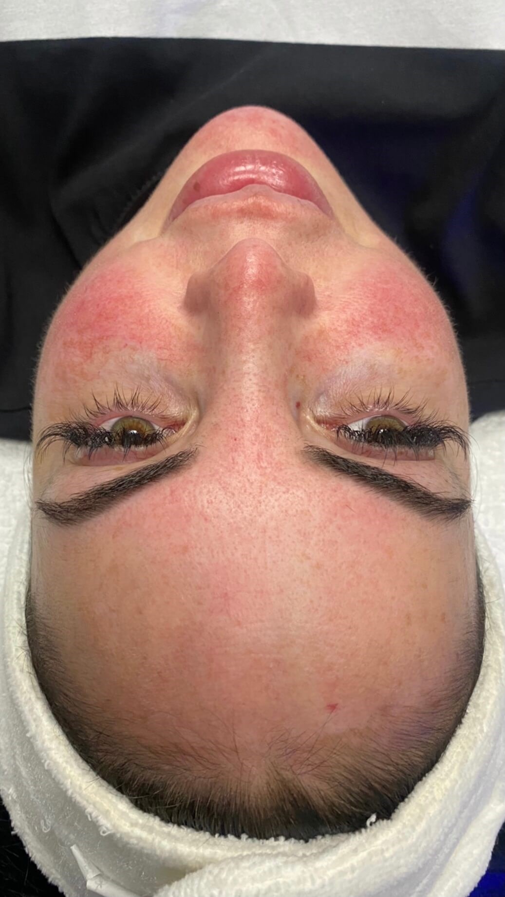 HydraFacial Before
