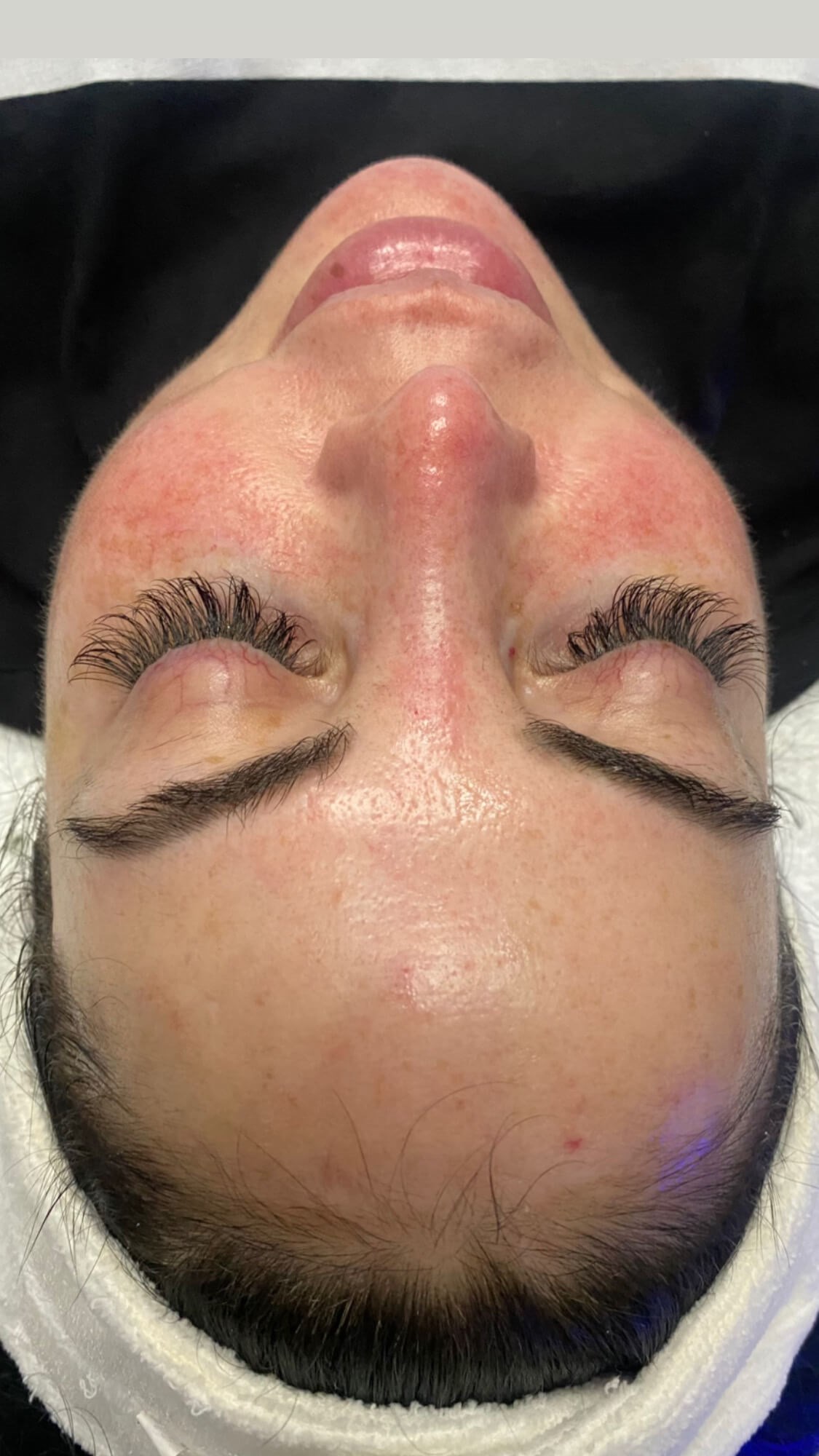 HydraFacial After