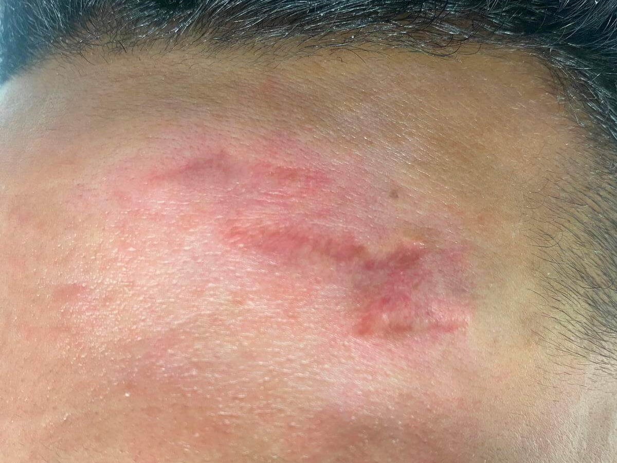 Scar Revision Before